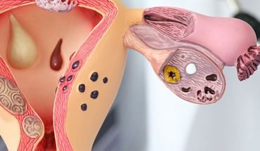 Gynecological-Cancers