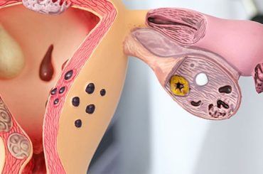 Gynecological-Cancers